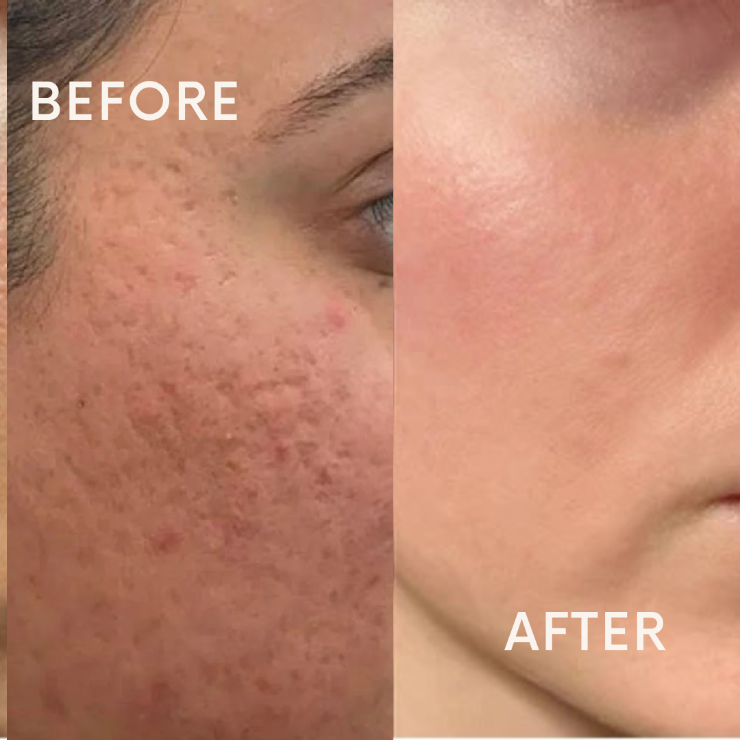 Open Pores & Dull Face Treatment Combo Kit