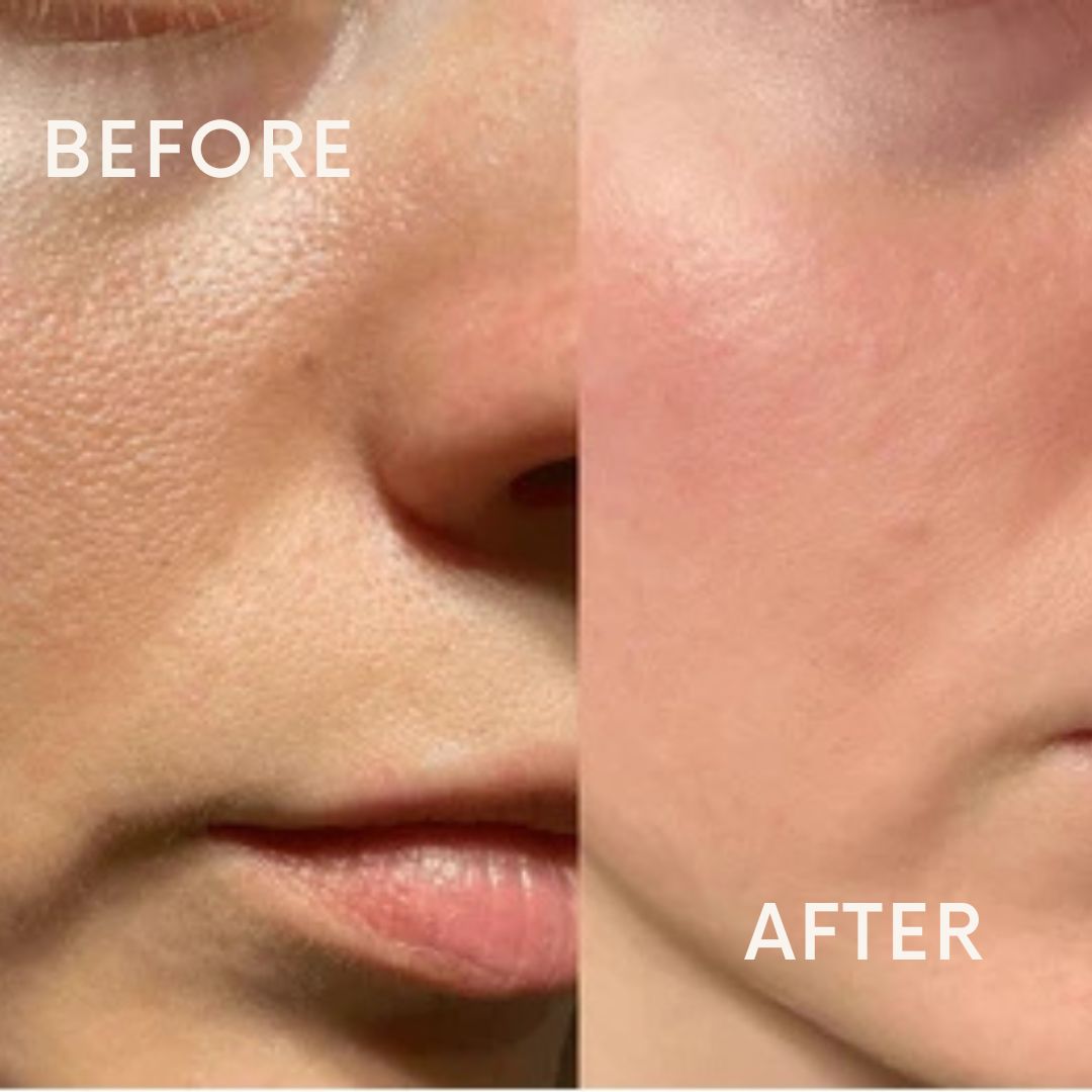 Open Pores & Dull Face Treatment Combo Kit