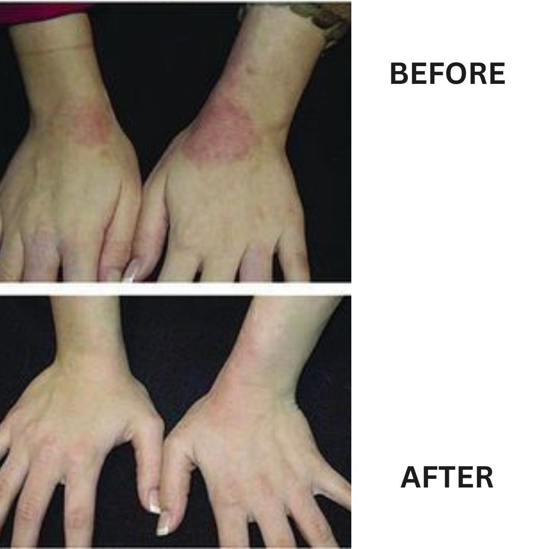 Psoriasis Treatment Kit